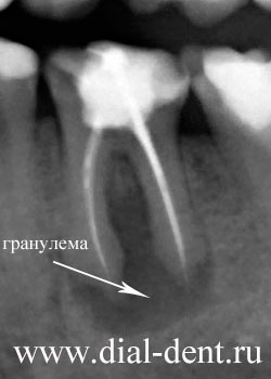 гранулема зуба, ситуация через год