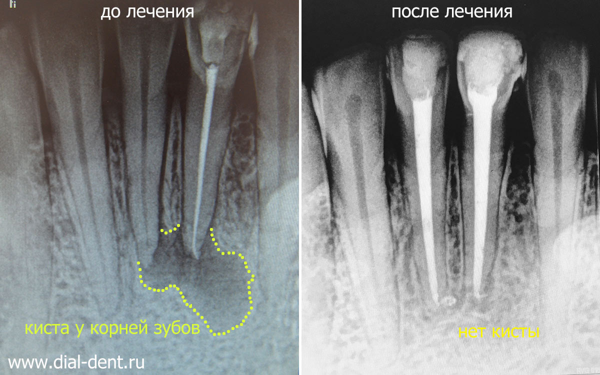 лечение зубов с микроскопом привело к полному исчезновению кисты зуба