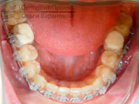 нижние зубы через 10 месяцев лечения брекетами