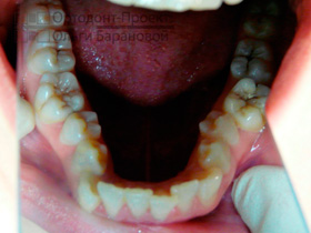 нижние зубы до начала лечения