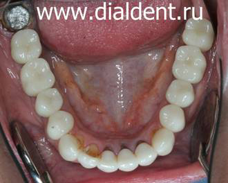 нижние зубы после лечения и протезирования зубов в Диал-Дент
