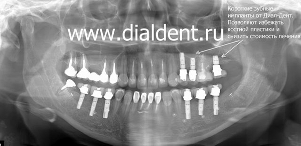 панорамный снимок зубов после лечения, имплантации и протезирования
