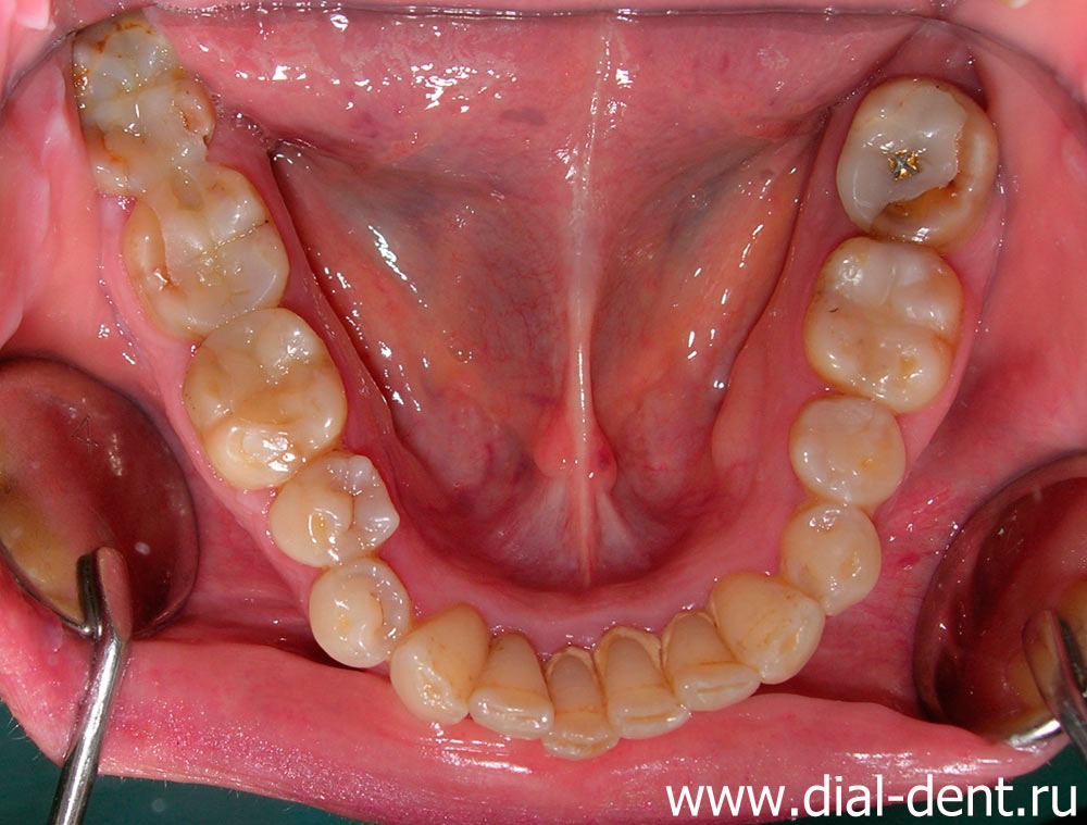 нижняя челюсть до реставрации зубов