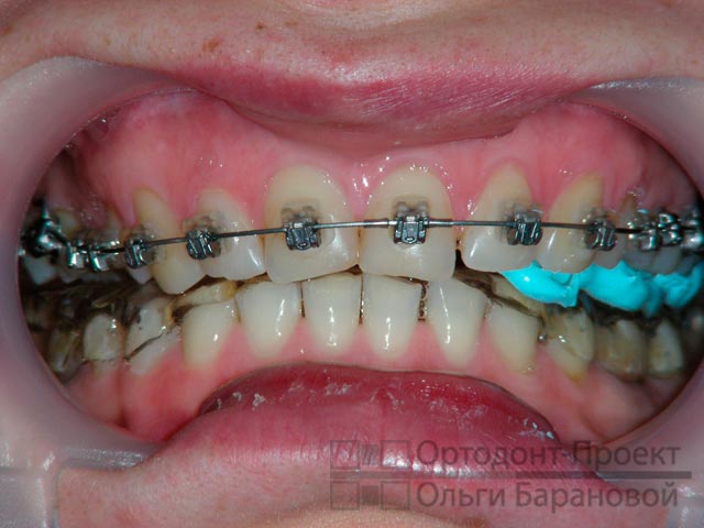 съемный ортотик и брекеты на верхних зубах