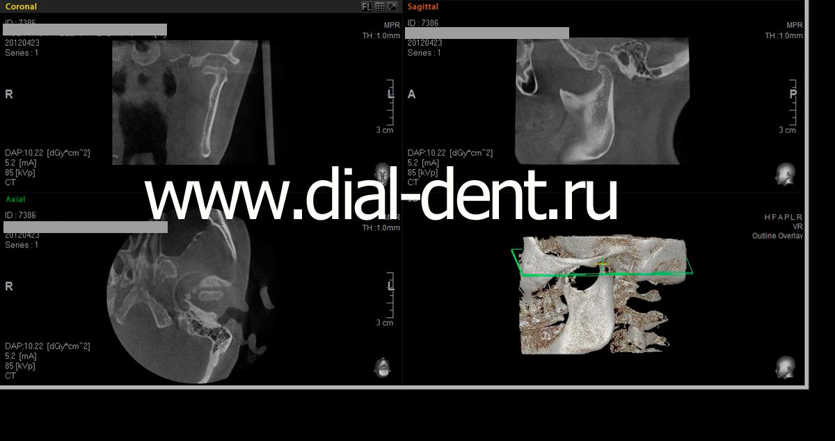 компьютерная томография левого ВНЧС с закрытым ртом