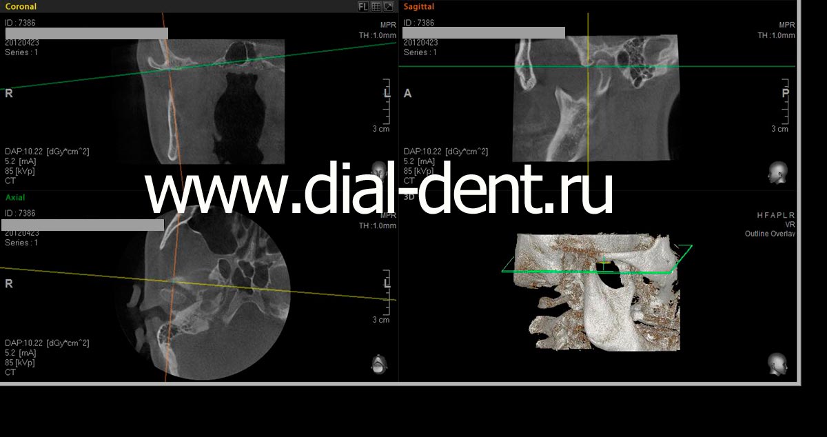 компьютерная томография правого ВНЧС с закрытым ртом