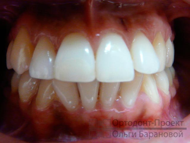 вид зубов при обращении к ортодонту