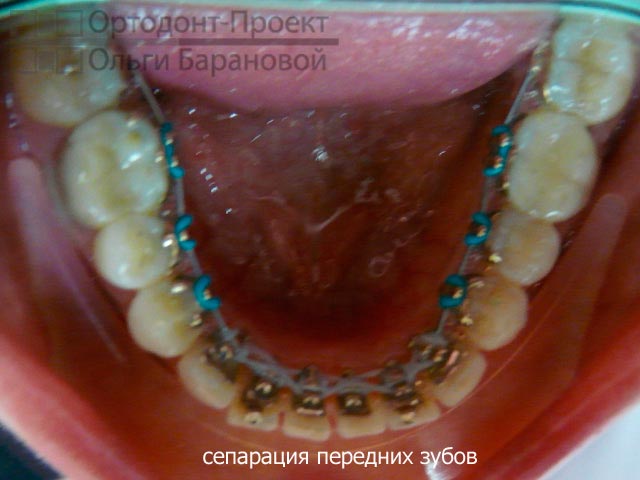 проведена сепарация нижних передних зубов