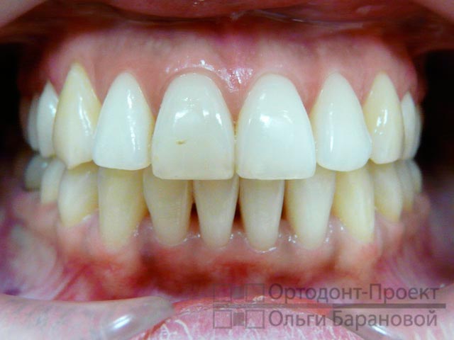 вид зубов после ортодонтического лечения у О.А. Барановой