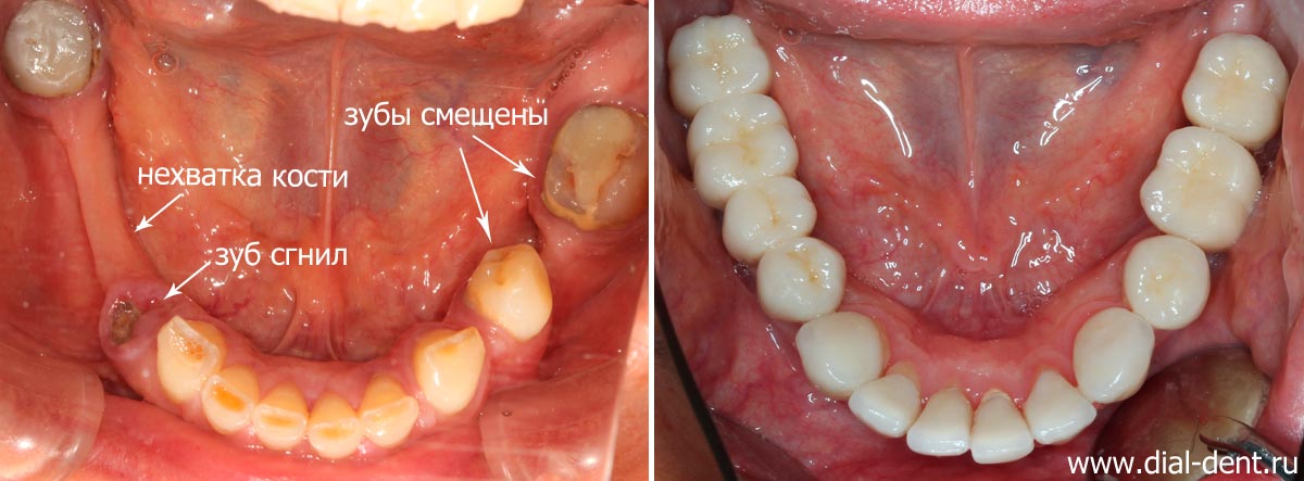 вид нижних зубов до и после лечения в Диал-Дент
