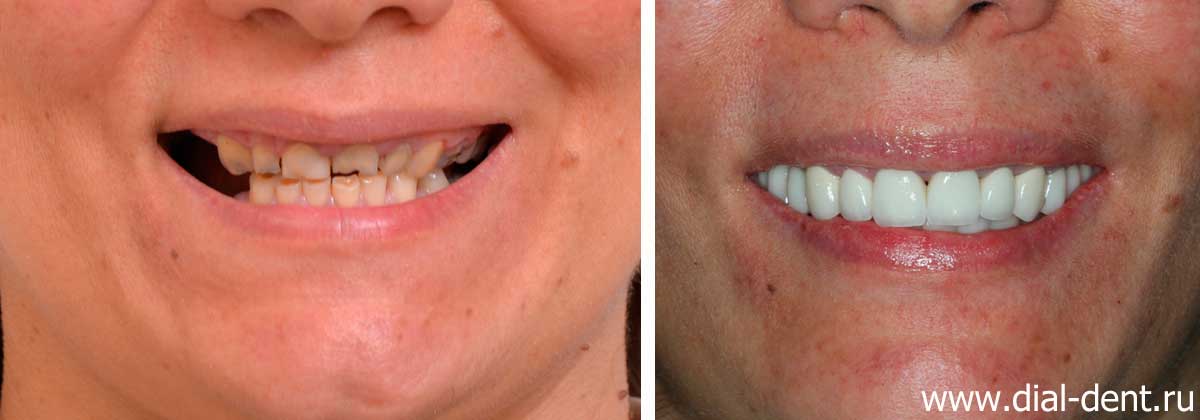 улыбка до и после лечения в Диал-Дент