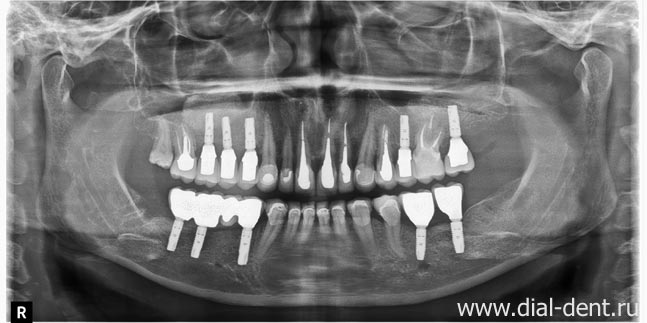 панорамный снимок зубов после лечения