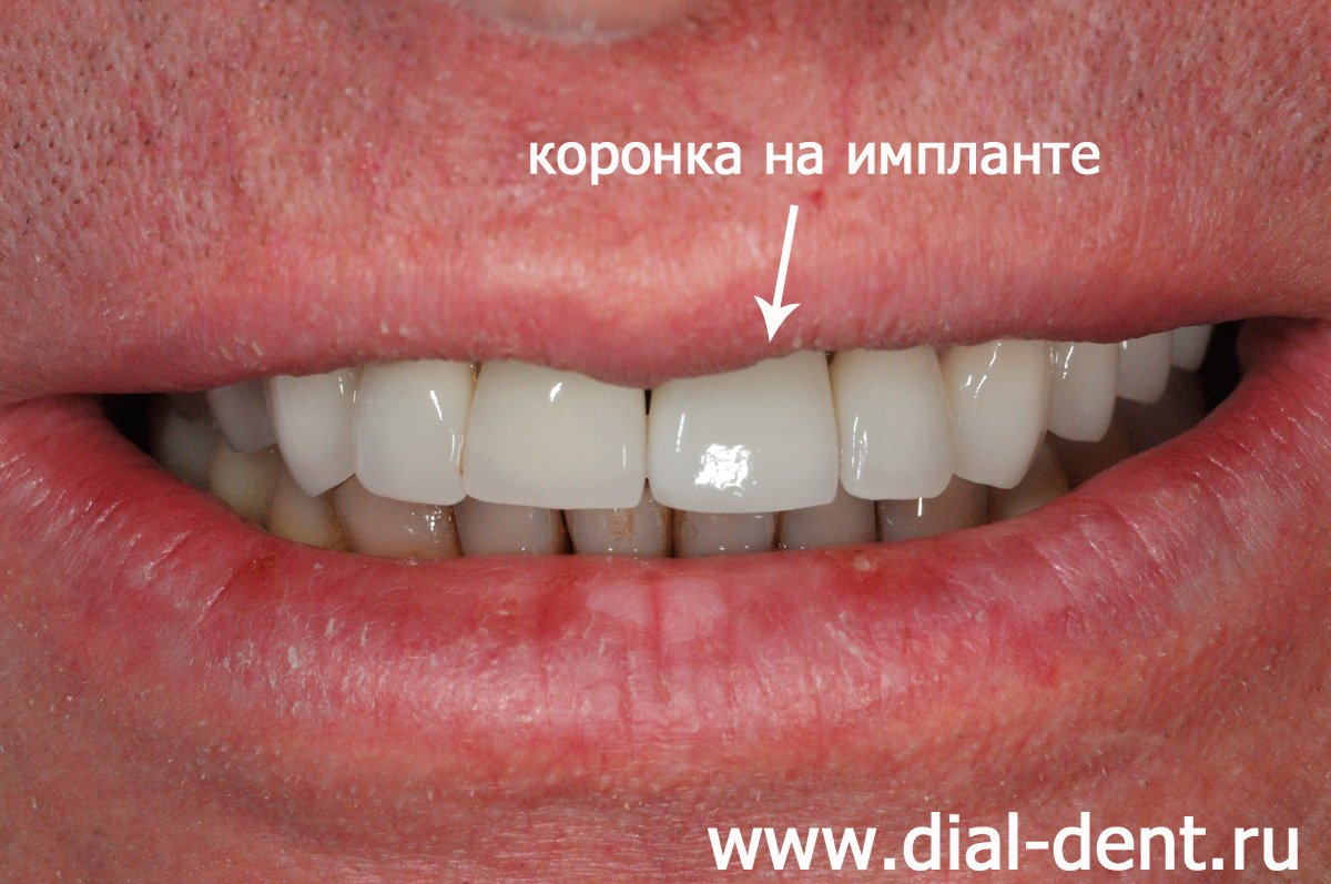 после удаления передний зуб восстановлен коронкой на импланте