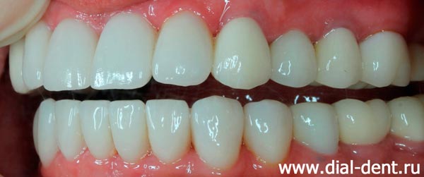 вид зубов после протезирования в Диал-Дент