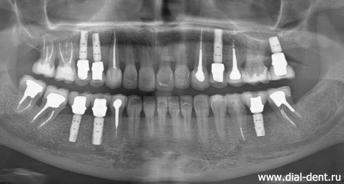 панорамный снимок зубов после проведенного комплексного лечения и протезирования зубов