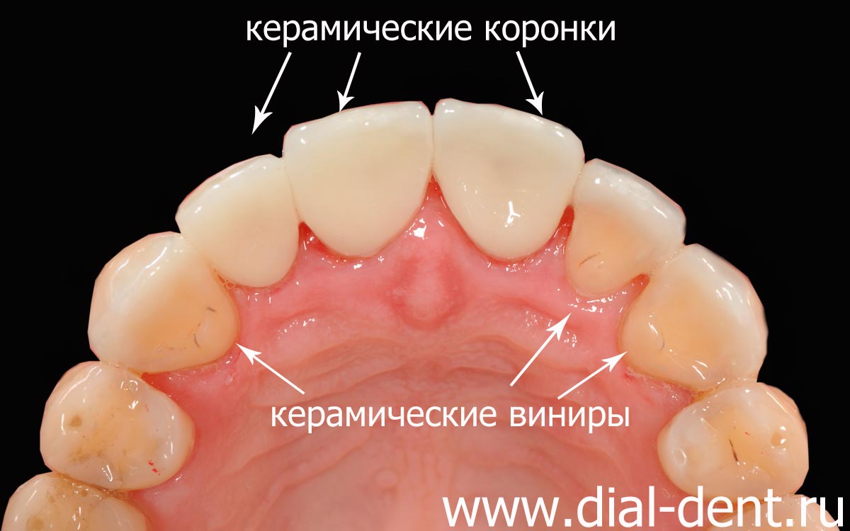 керамические коронки и виниры установлены на зубы