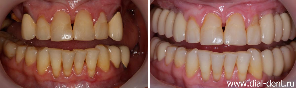 вид зубов до и после протезирования на имплантах