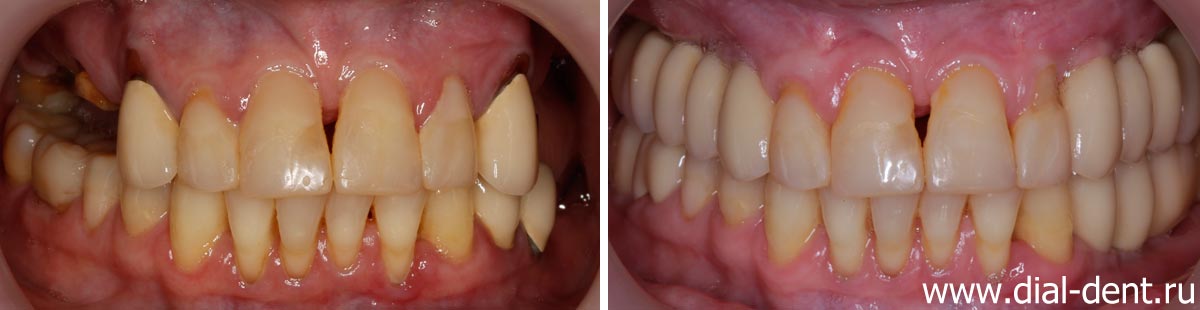 вид зубов до и после протезирования на имплантах