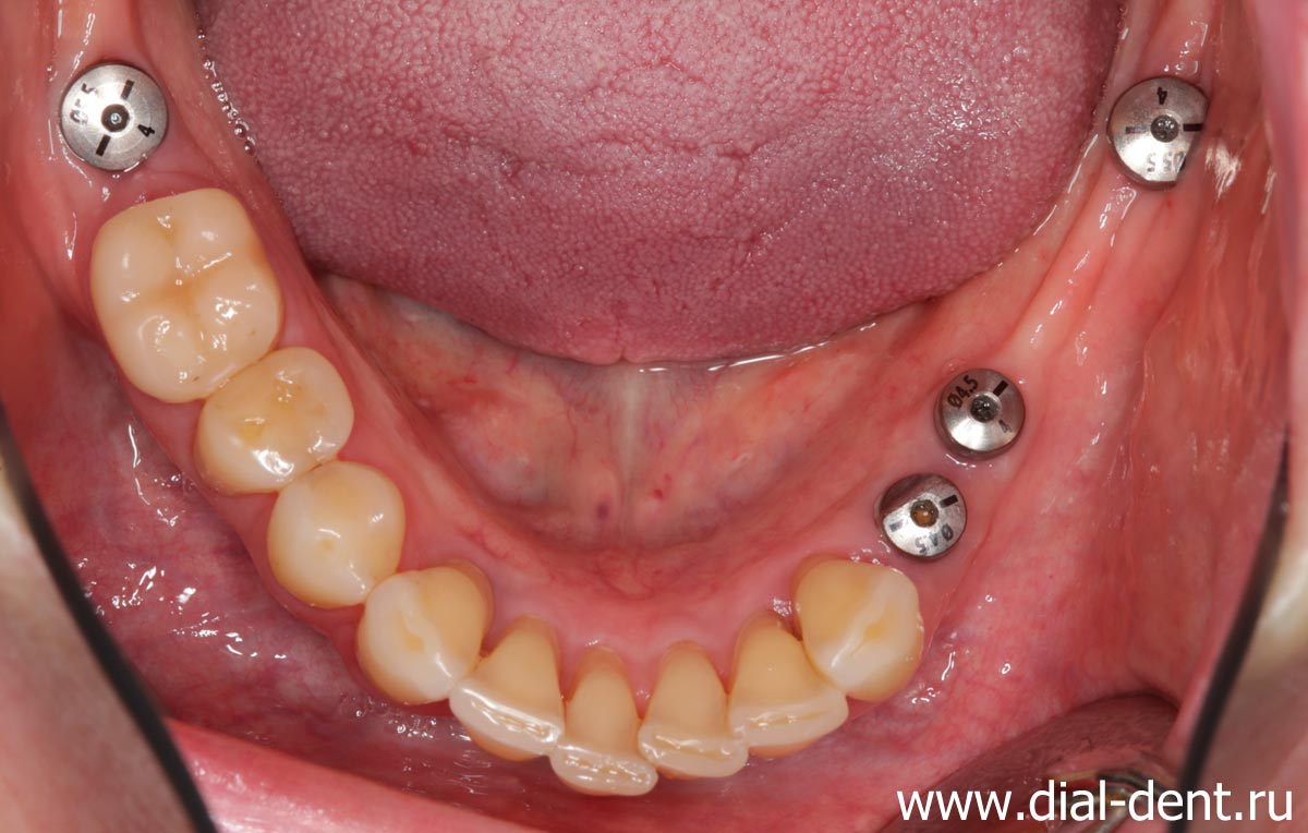 зубные импланты Astra Tech с формирователями десны на нижней челюсти