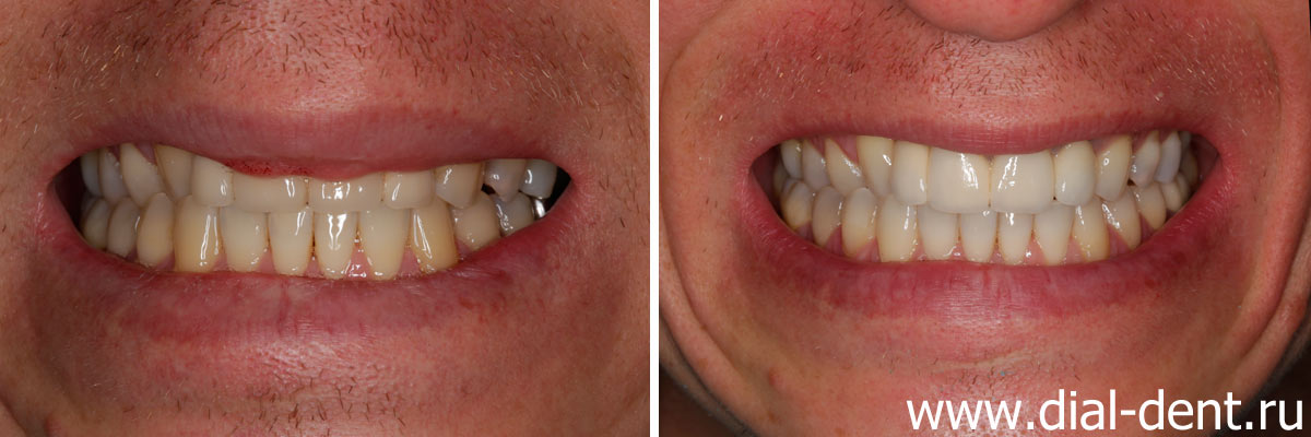 улыбка до и после протезирования зубов керамикой