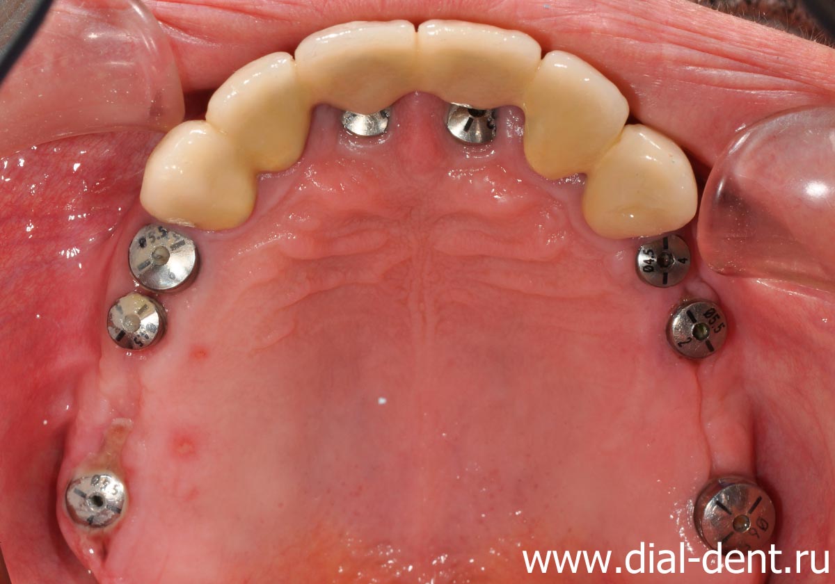 установлены зубные импланты Astra Tech на верхней челюсти