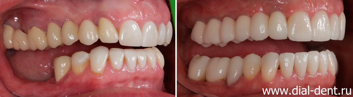 вид справа до и после протезирования зубов