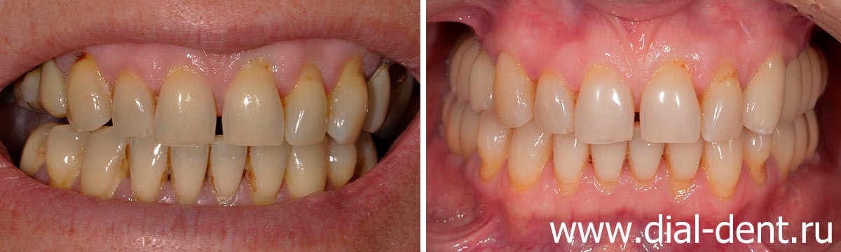 до и после протезирования жевательных зубов керамическими коронками