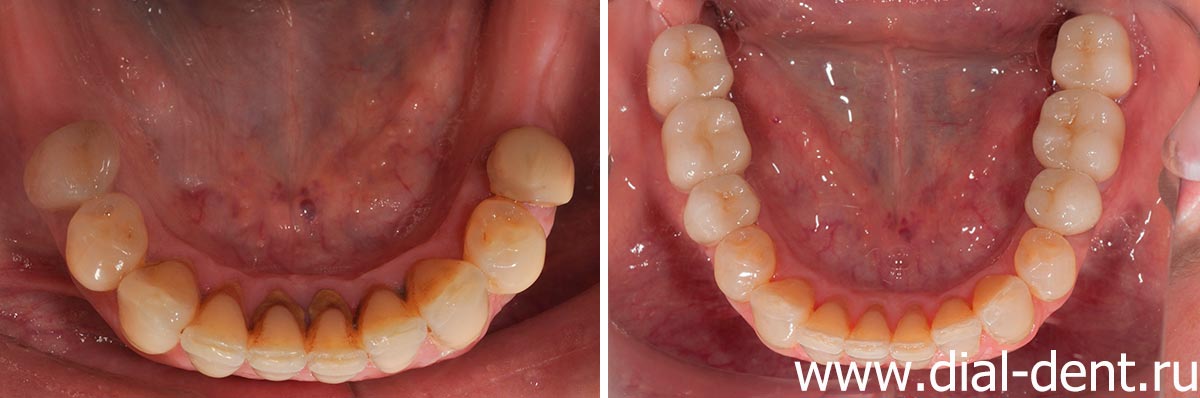 нижние зубы до и после протезирования жевательных зубов керамическими коронками