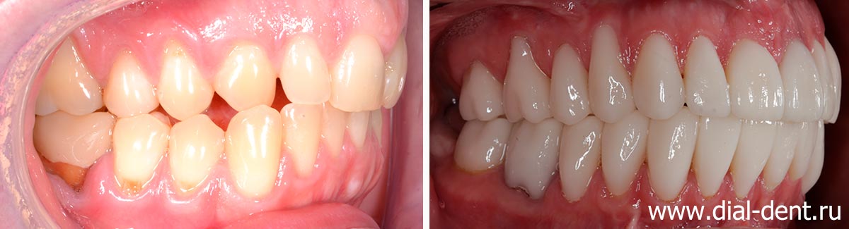вид зубов справа до и после исправления прикуса и протезирования
