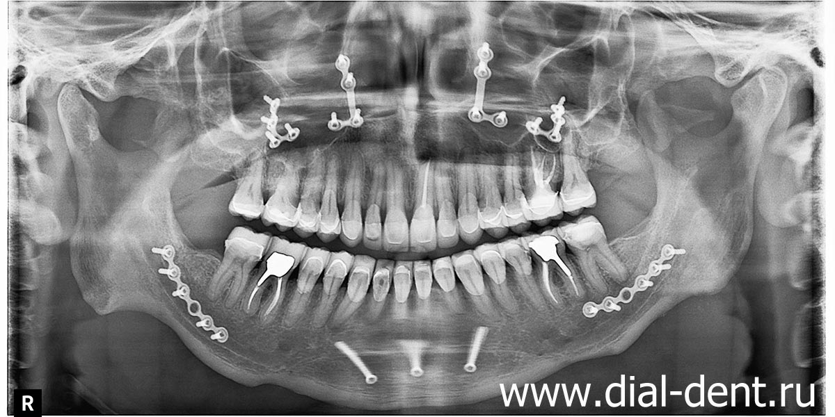 панорамный снимок после хирургического исправления прикуса и протезирования зубов