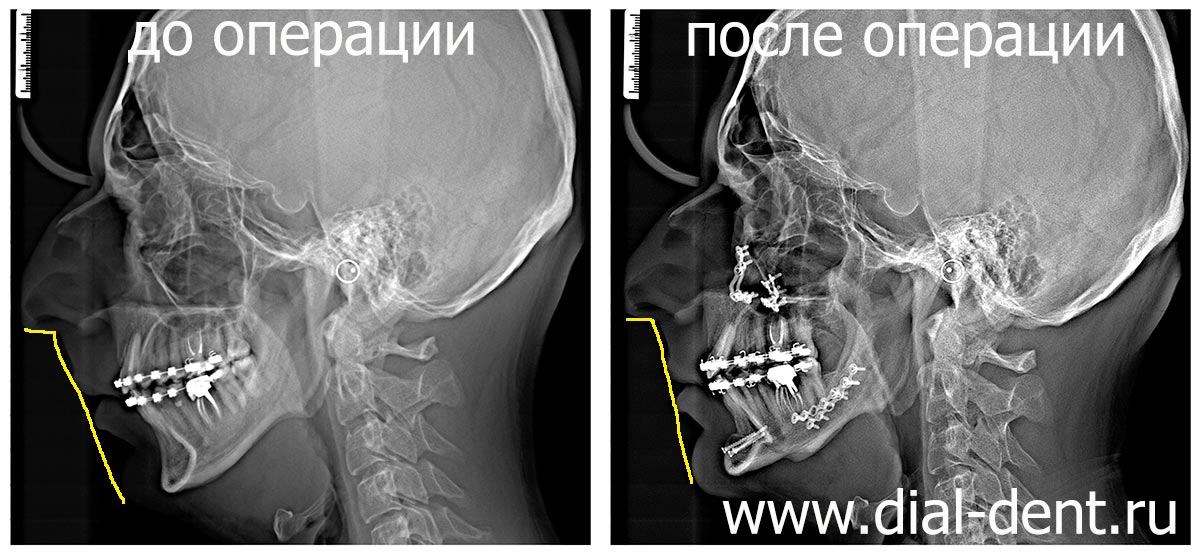 рентгеновские снимки до и после операции по исправлению прикуса