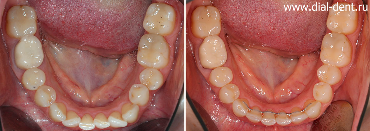 нижние зубы до и после лечения и протезирования в Диал-Дент