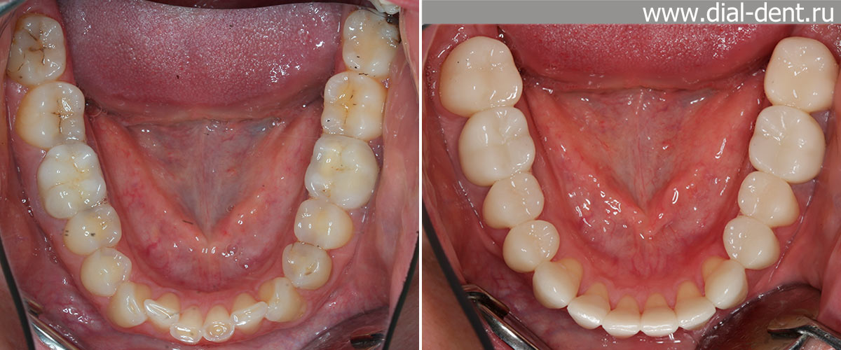 вид нижних зубов до и после комплексного лечения с протезированием зубов