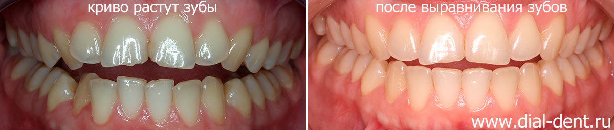 до и после выравнивания зубов брекетами