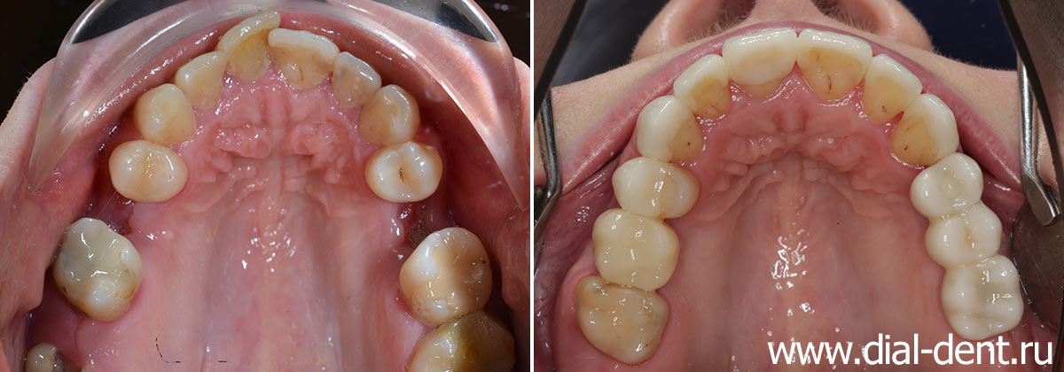 верхние зубы до и после комплексного лечения в Диал-Дент