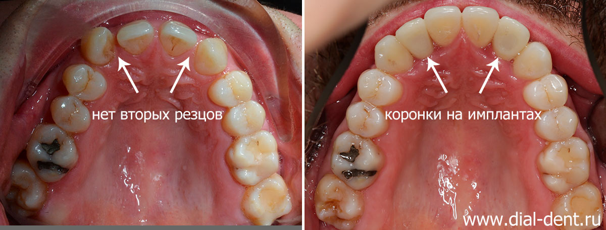 верхние зубы до и после комплексного лечения