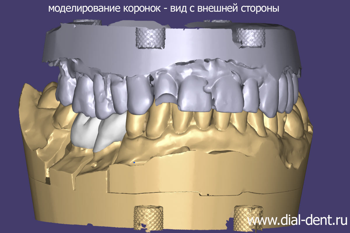 компьютерное моделирование зубных коронок