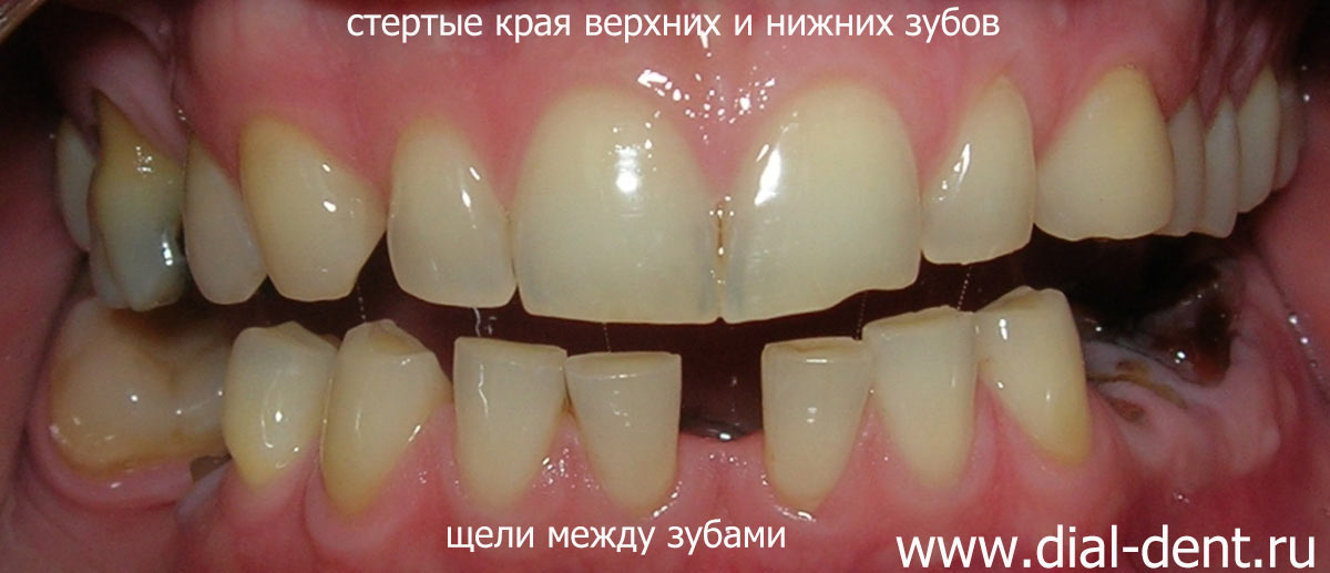 вид зубов до лечения - отсутствие зубов, щели между зубами, стираемость зубов
