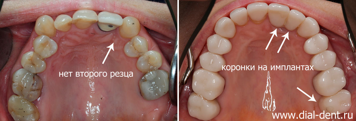 вид верхних зубов до и после исправления прикуса и протезирования