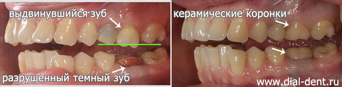 до и после протезирования зубов фото