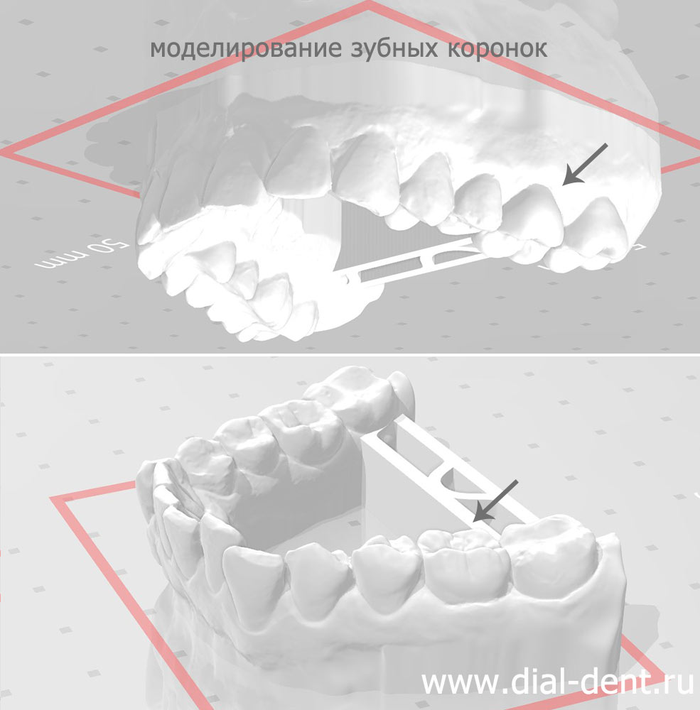 моделирование зубных коронок