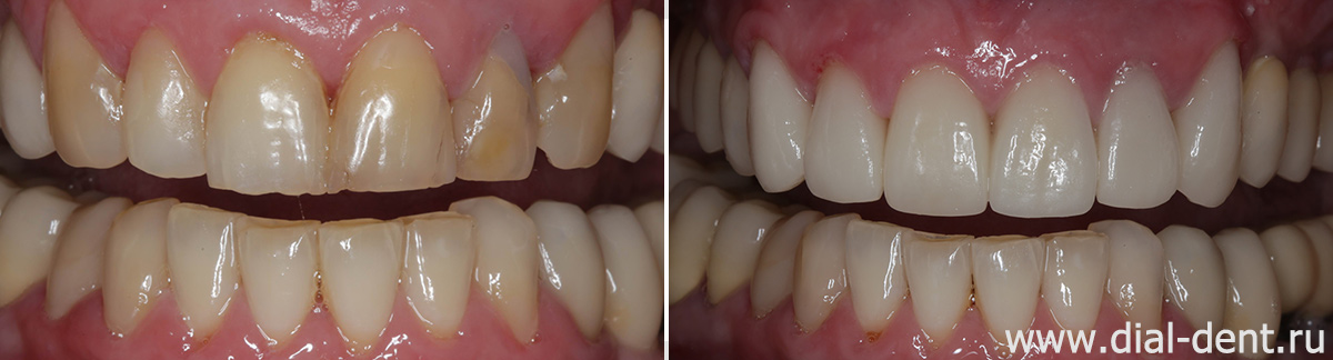 вид зубов до и после протезирования верхних зубов керамикой
