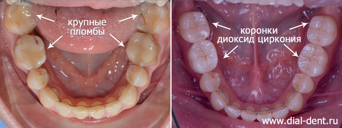 вид нижних зубов до и после комплексного лечения в Диал-Дент