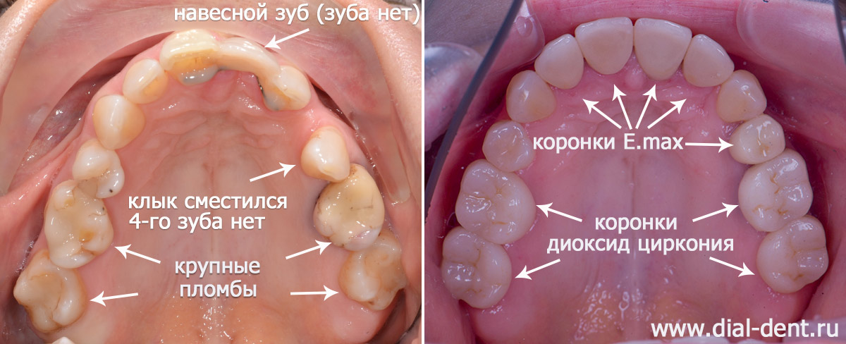 вид верхних зубов до и после комплексного лечения в Диал-Дент
