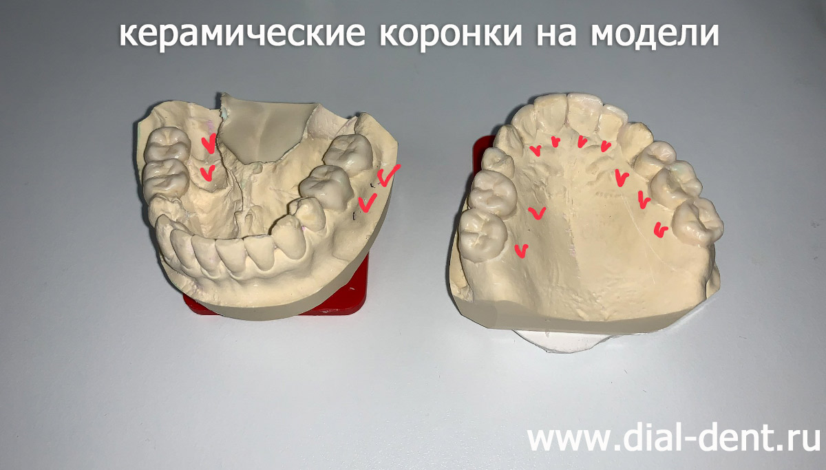 керамические коронки на модели зубов