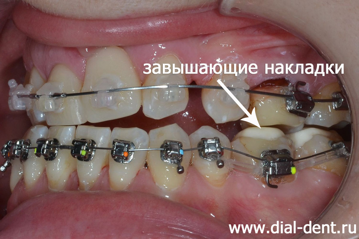лечение брекетами - применение ортодонтических накладок для разобщения прикуса