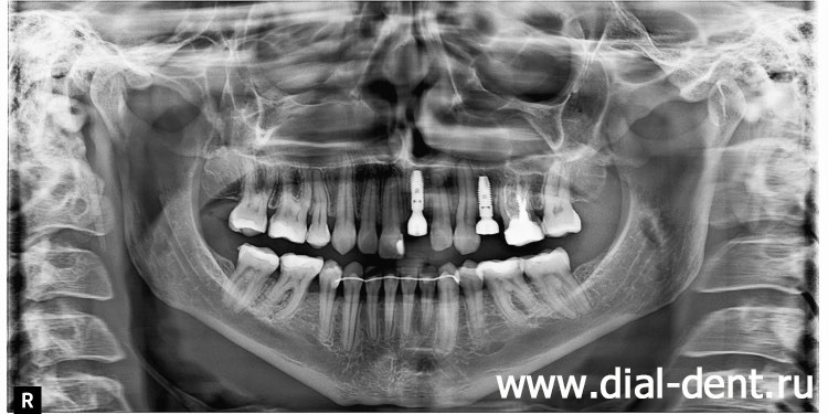 панорамный снимок после установки зубных имплантов