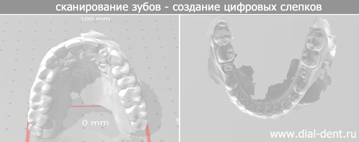 цифровые модели челюстей по результатам сканирования зубов