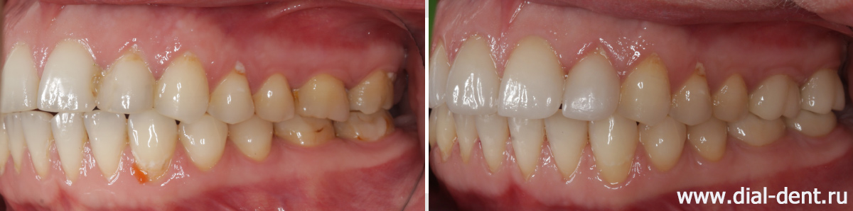 до и после реставрации зубов вид слева