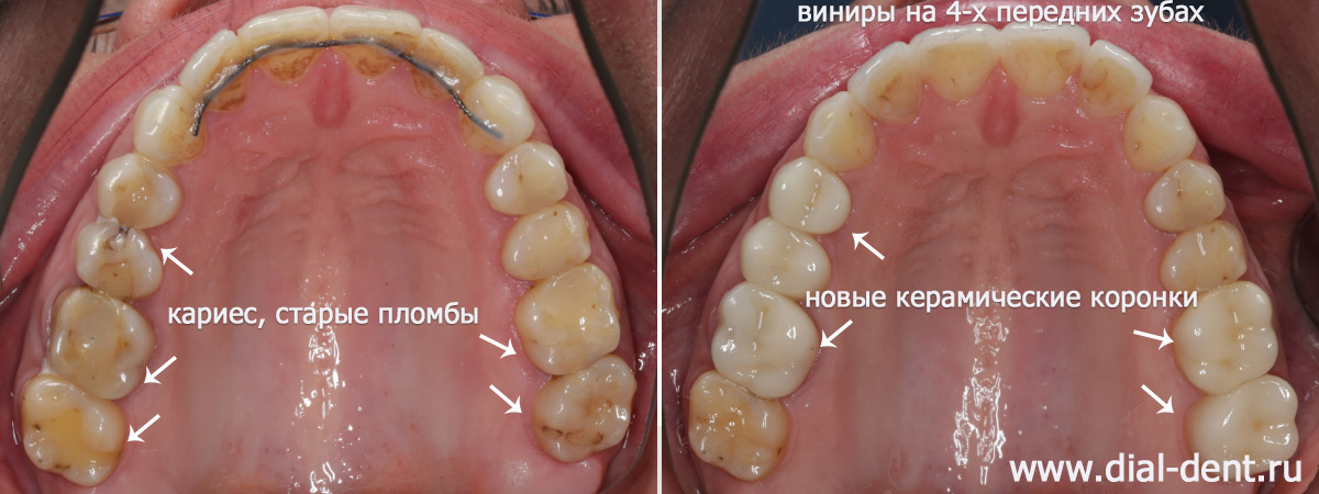 верхние зубы до и после реставрации